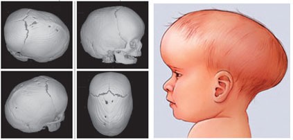 Aspecto tomográfico da escafocefalia e esquema clínico da deformidade craniana.