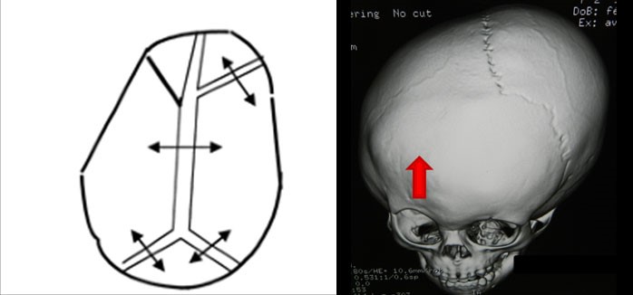 Plagiocefalia anterior1