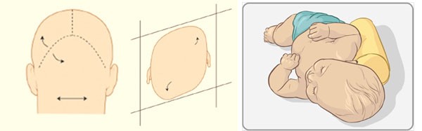 Plagiocefalia deformacional com seu aspecto em paralelogramo e o seu tratamento clínico com medidas posturais.