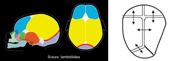 Suturas lambdóides assinaladas e esquema de uma plagiocefalia posterior mostrando o crescimento compensatório através das suturas não acometidas