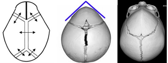 Esquema e aspecto tomográfico de uma trigonocefalia, com fechamento precoce da sutura metópica e aspecto triangular da fronte