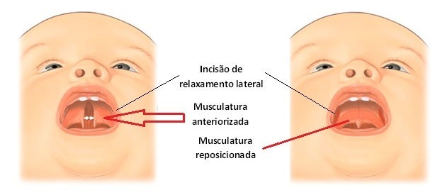 Esquema da cirurgia de palato mostrando a musculatura do véu palatino anteriorizada, o local das incisões de relaxamento lateral e a musculatura reposicionada após o fechamento da fissura