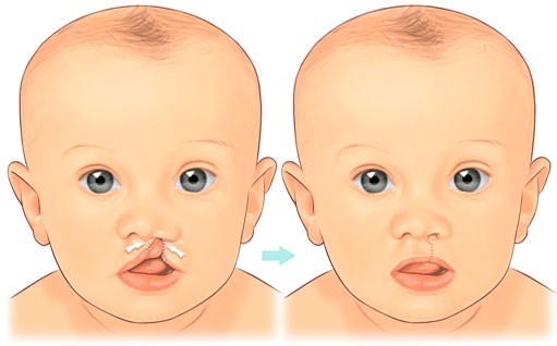 Esquema do fechamento de fissura de lábio unilateral esquerda